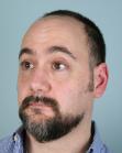 Before Hair Transplant&nbsp;Front